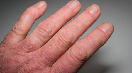 Psoriatic arthritis – symptoms, causes, diagnosis, and treatment
