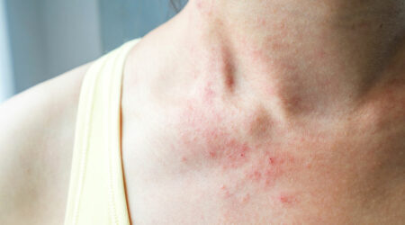 Skin rashes – Everything there is to know