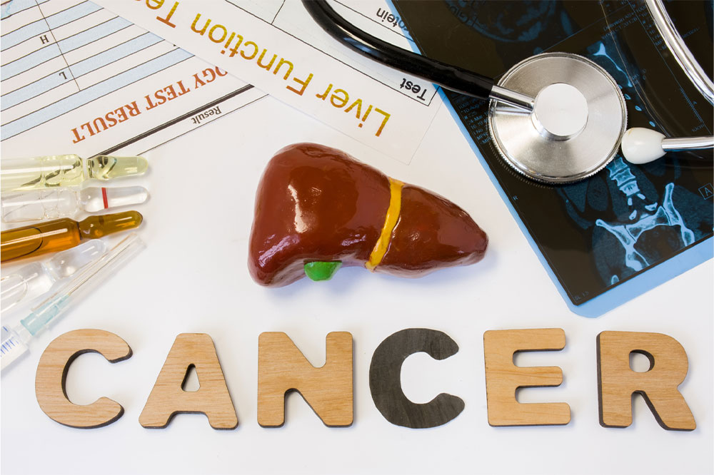 4 essential things to know about liver cancer
