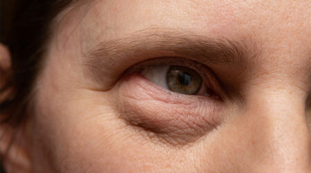 9 benefits of undergoing a blepharoplasty procedure