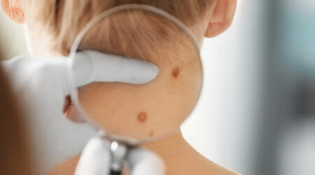 Melanoma – Causes, signs, and management
