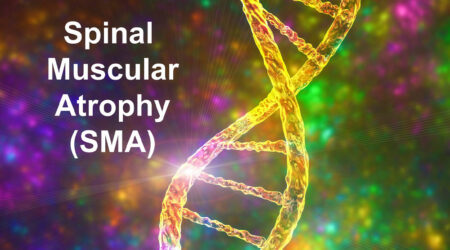 Types, signs and diagnosis of spinal muscular atrophy