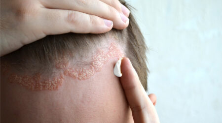 Essential factors linked to scalp psoriasis