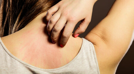Important factors to know about eczema