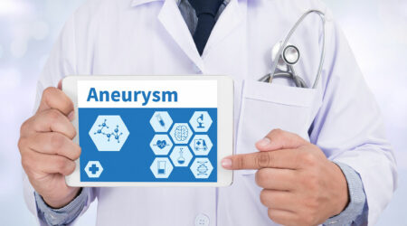 Aneurysms – Causes, symptoms, types, and prevention