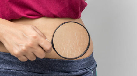 Managing stretch marks – Remedies and techniques to remember
