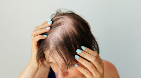 Alopecia areata – Symptoms, causes, and management options