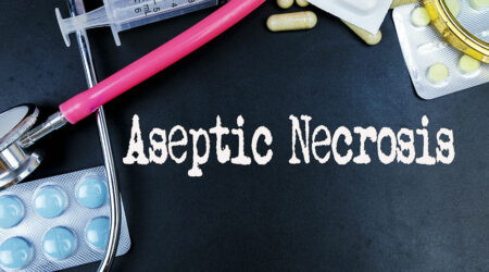 Aseptic necrosis – Symptoms, causes, and management