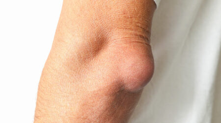 Bursitis – Types, symptoms, and management