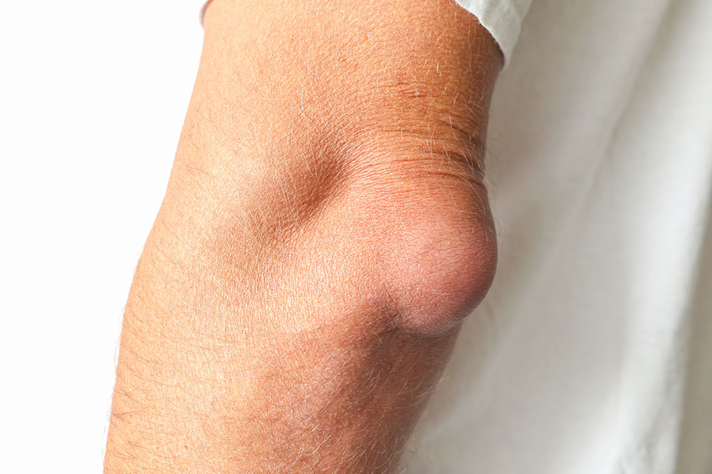 Bursitis – Types, symptoms, and management