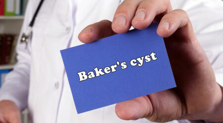 Baker’s cyst – Symptoms, causes, and management