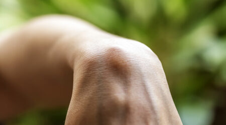 Bible cyst – Causes, symptoms, and prevention