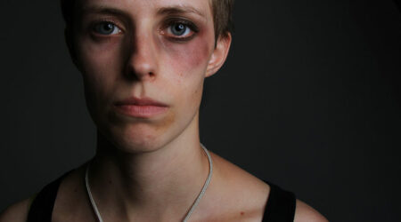 Black eye – Signs, causes, and management