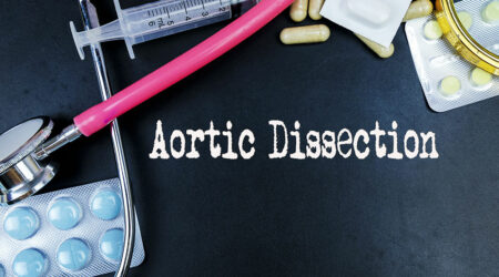 Key factors to know about aortic dissection