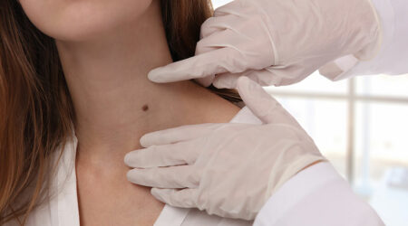Symptoms, causes, and more about skin tags