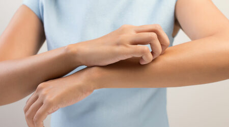 Symptoms of mosquito bites and how to manage them