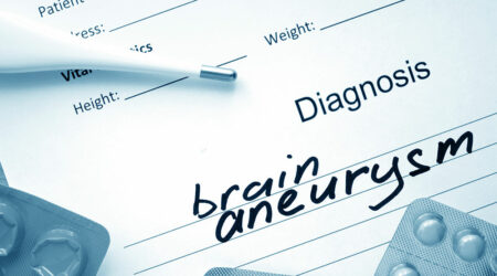 Things to know about a brain aneurysm