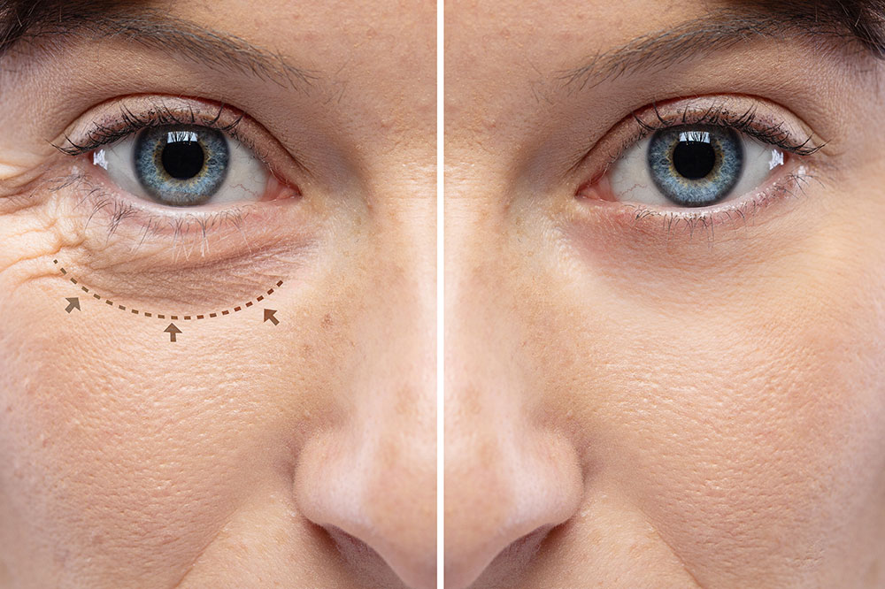 6 tips for finding the best blepharoplasty surgeons